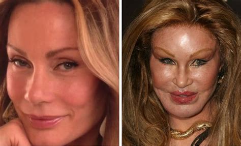 plastic surgery gone wrong photos.